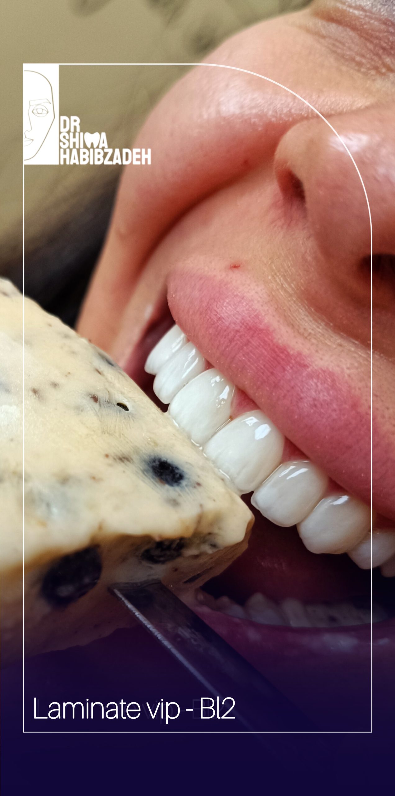 لمینیت سرامیکی VIP مطب دندانپزشکی دکتر شیما حبیب زاده